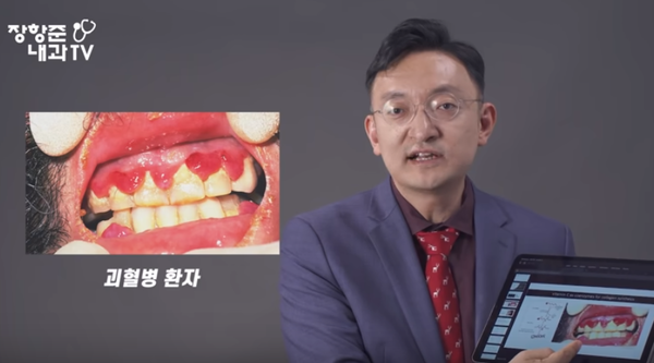 비타민C가 부족하면 혈관조직이 약해져 출혈이 일어나게 되고 괴혈병에 걸리게 된다. 장항준 유튜브 채널 캡쳐