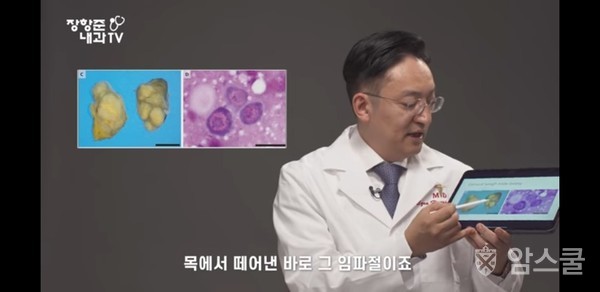 2013년 콜롬비아 남성에게서 떼어낸 임파절 (좌), 임파절에서 떼어낸 암세포 조직 (우) 미국 CDC 검사결과 이 세포는 기생충인 소형 조충 세포임이 밝혀졌다. 장항준 내과 TV 캡쳐