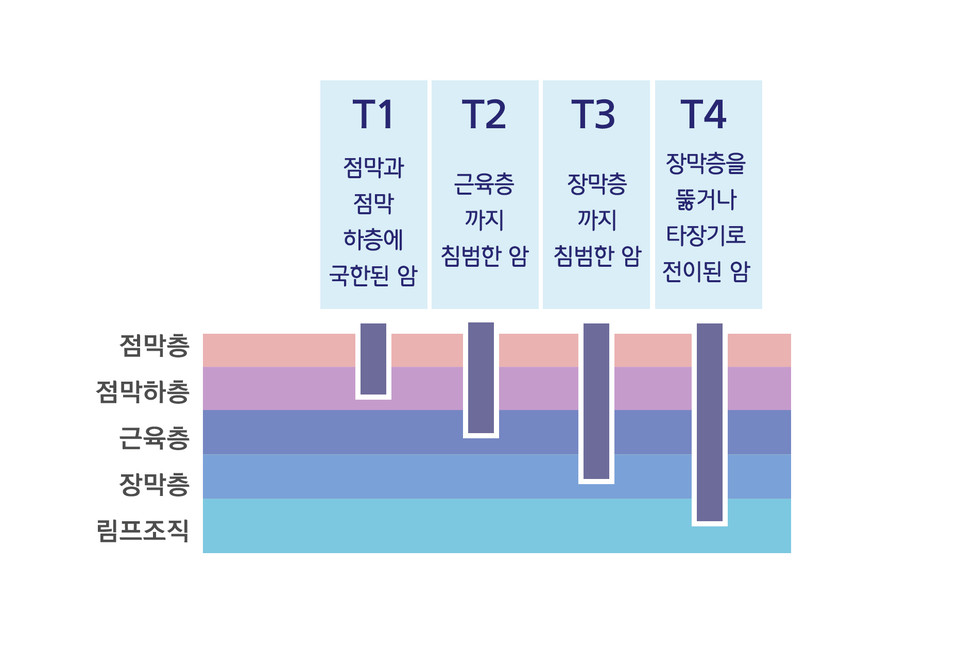 TNM 분류법에 따른 위암 종양의 조직 침범 정도 