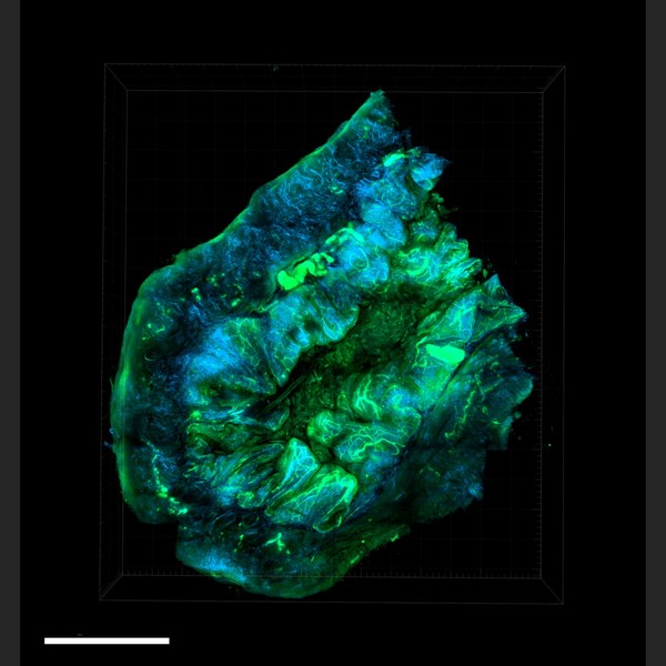 난소 종양 미세 환경. 출처 미국립암연구소