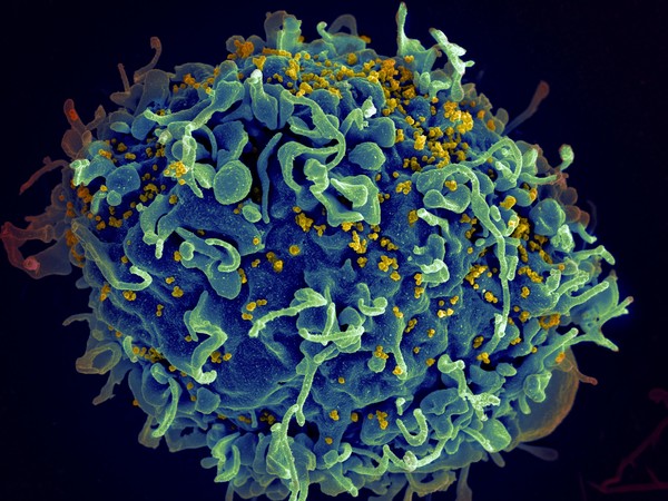 HIV, AIDS 바이러스(노란색)가 인간세포를 감염시키고 있다. 출처 미국립암연구소 
