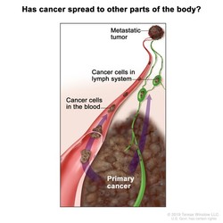 흑색종에서 혈액과 림프계를 통해 신체의 다른 부분으로 퍼지는 암세포를 보여준다. NCI