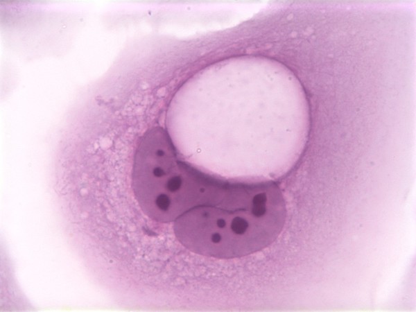 koilocyte는 인유두종 바이러스(HPV) 감염의 결과로 구조적 변화를 겪은 편평 상피 세포다. 이 이미지는 HPV-16 E5 및 E6 종양단백질을 발현하는 인간 포피 각질세포(HFK)를 보여준다. 미국립암연구소 제공