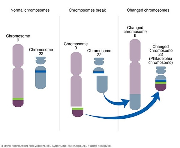 필라델피아 염색체(Philadelphia chromosome)