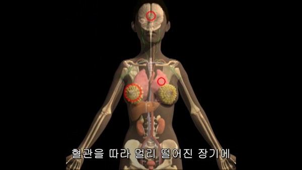 유방암 전이 기관. 출처 국가암정보센터