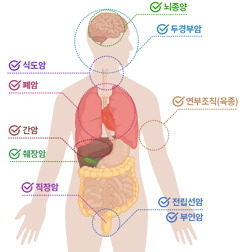     출처 서울대학교병원기장암센터