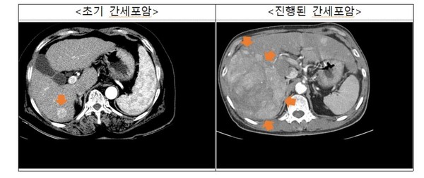 간세포암 영상(CT). 출처 국민건강보험공단