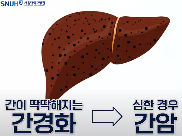 간경화, 간암으로 이어지는 B형 간염. 제공 서울대학교병원