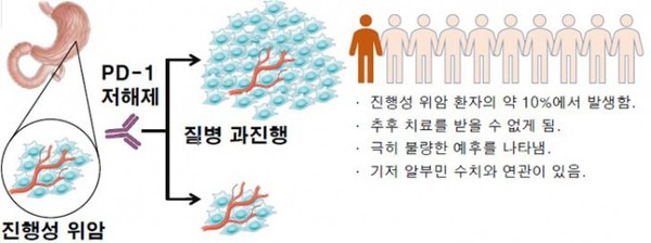 진행성 위암 환자에서 면역관문억제제(PD-1 저해제) 투여에 따른 결과. 출처 세브란스병원
