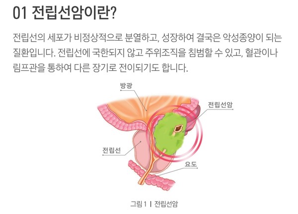 전립선암은 세계적으로 남성에서 발병하는 암 중 2번째로 흔한 암이다. 출처 삼성서울병원 암교육센터