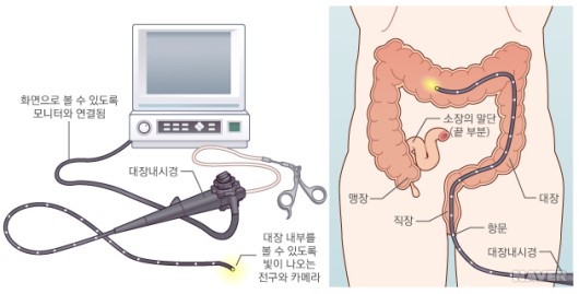   대장내시경 모식도. 출처 네이버