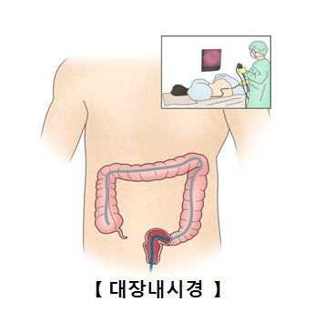 대장내시경 이미지. 출처 서울아산병원