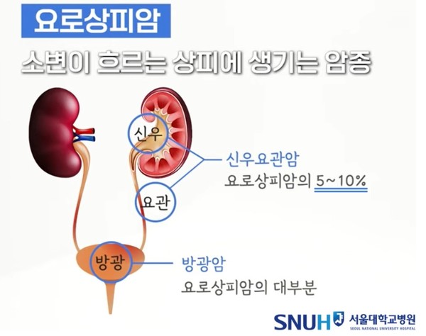 암종이 방광에 생기면 방광암, 신우나 요관에 생기면 신우요관암이 된다. 출처 서울대학교병원 블로그