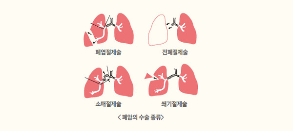 출처 삼성서울병원