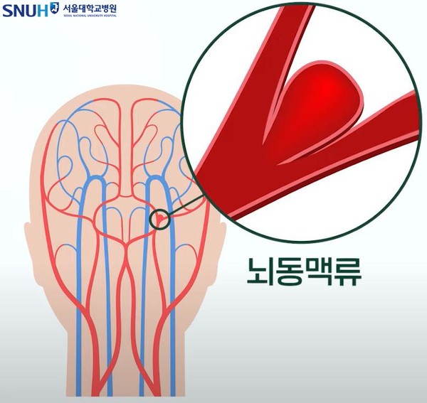 뇌동맥류. 출처 서울대병원