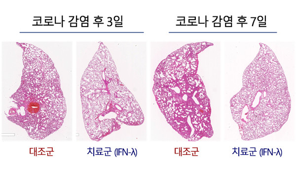 폐 조직분석 결과. 출처 서울대병원