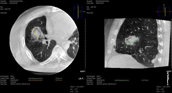대장암 폐 전이 고주파 열 치료 시술 직후 Cone Beam CT 소견 . 출처  강북삼성병원
