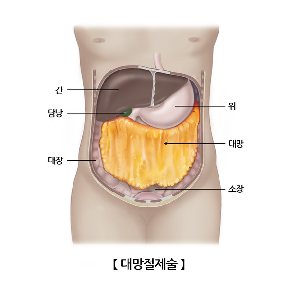 대망 절제술 그림. 출처 서울아산병원