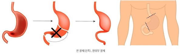 원위부 절제. 출처 서울대병원
