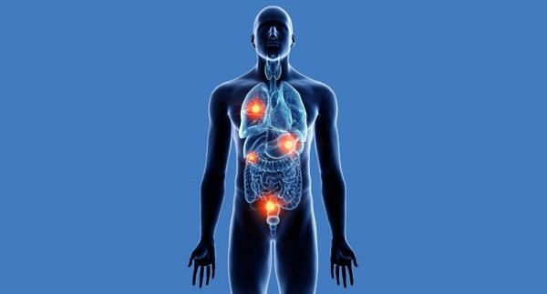 환자가 자신의 암이 4기라는 말을 듣는 경우, 희소전이암인지 여부를 의사에게 물어야 한다. 출처 엠디앤더슨 암센터