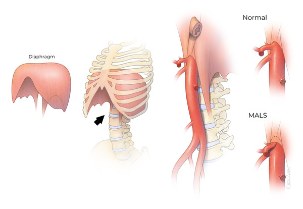 정중궁인대증후군(MALS) 환자는 대동맥이 복부로 들어갈 때 첫 번째 큰 가지인 체강 동맥을 심하게 압박한다.  출처 미국 McGovern Medical School