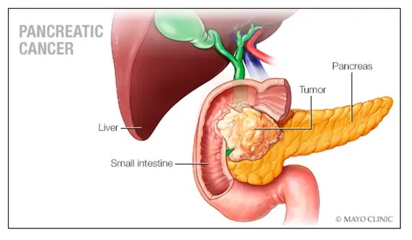 췌장암을 진단받은 환자가 작은 수술을 수행하면 암 확산을 조기에 식별하고 암의 단계를 결정 하는데 도움이 된다는 연구결과가 나왔다. 출처 메이요클리닉