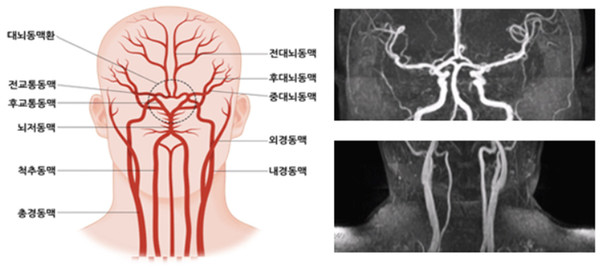 뇌혈관의 구조. 출처 질병관리청