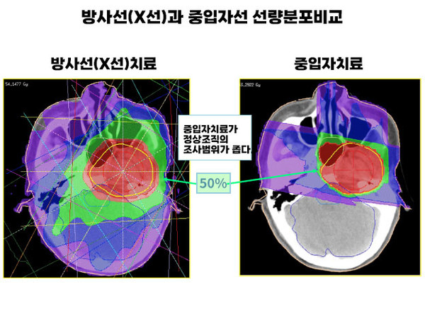 방사선(X선) 보다 중입자선이 주위 기관에 영향을 미치지 않는 것을 볼 수 있다. 일본 방사선의학종합연구소(QST병원) 자료 