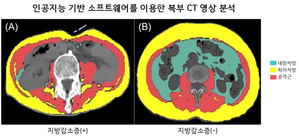 인공지능 기반 소프트웨어로 체성분 분석한 루게릭병 환자의 복부 CT영상. 지방감소증 동반한 환자 (A)는 CT검사 1개월째 사망한 반면, 지방감소증 동반하지 않은 환자 (B)는 35개월(관찰기간) 동안 생존함. 출처 서울대병원