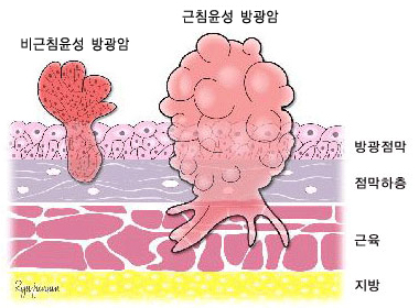 진행 단계에 따른 방광암의 분류. 출처 국가암정보센터