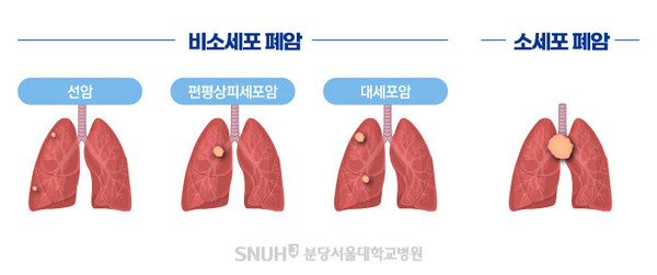 폐암의 종류. 출처 분당서울대학교병원