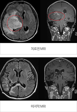 교모세포종 관련 MRI. 출처 서울성모병원