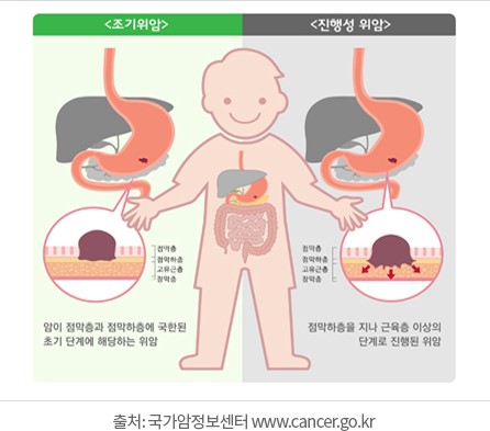 출처 가톨릭대학교 성빈센트암병원
