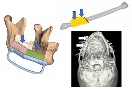 디지털 프로그램과 3D 프린팅 기술을 이용해 광범위한 구강암 수술 후 턱뼈를 정교하게 재건했다. 출처 서울대병원