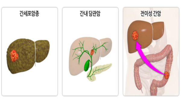 간암의 종류. 출처 서울대학교병원