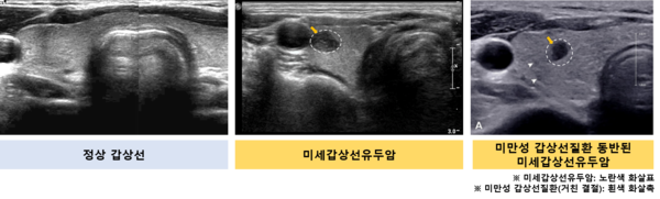 갑상선 초음파 비교 (왼쪽부터 정상 갑상선, 미세갑상선유두암, 미만성 갑상선질환 동반된 미세갑상선유두암). 출처 서울대병원