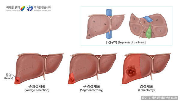 절제 가능한 중간 병기의 간암에서 일부 환자의 경우 간 절제 치료가 효과적일 수 있다는 연구 결과가 나왔다. 출처 국가암정보센터