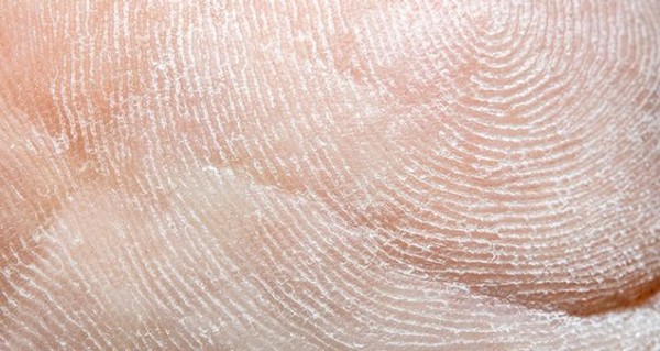 편평세포 암은 흔히 분홍색의 단단한 돌기나 비늘 모양의 거친 반점으로 형성된다.
