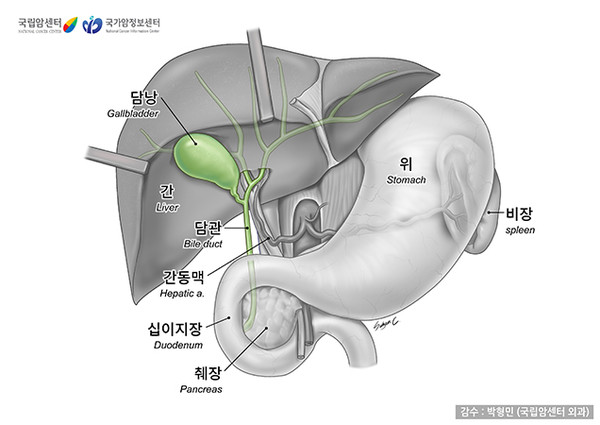 담낭암은 담낭의 벽에 암세포가 생길 때 발병한다.  출처 국가암정보센터