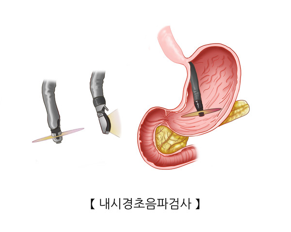서울아산병원 
