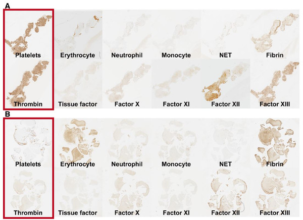 ▲암과 연관된 뇌졸중 환자의 혈전 샘플(A) 가운데 혈소판(Platelets)과 트롬빈(Thrombin)이 일반적인 뇌졸중 환자의 혈전 샘플(B)과 비교해 더 진하게 염색되어 있다. 출처 세브란스