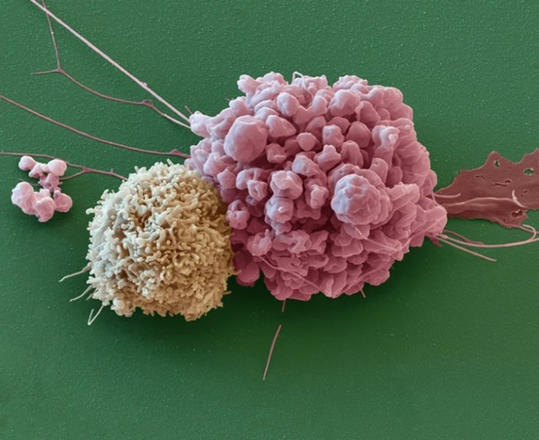 신경계 암세포 옆에 있는 면역세포(왼쪽).  ⓒ Eye of Science