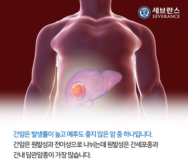 세브란스병원 의료진이 최근 국내 처음으로 비가역적 전기 천공법을 이용해 간암 환자를 치료했다. 출처 세브란스
