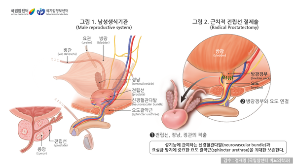 전립선암 진단 시 전립선특이항원(PSA) 수치가 4~10ng/mL인 환자에서 전립선건강지수(PHI)를 활용하면 불필요한 MRI를 최대 20.1%까지 줄일 수 있다는 연구 결과가 나왔다. 출처 국가암정보센터