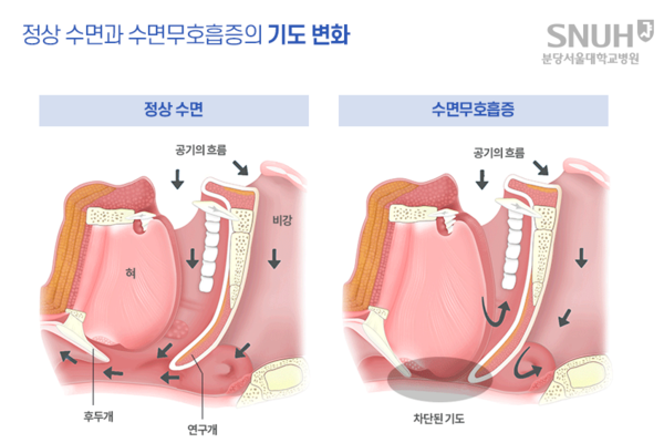 암 환자 40%가 수면무호흡증이 나타나며 이로 인해 심부전 위험도 높아지는 것으로 나타났다. 출처 분당서울대병원