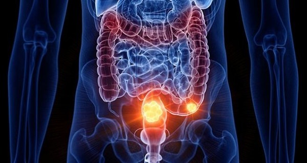 대장암은 결장암과 직장암을 총칭하는 용어다. 연구에 따르면 대장암은 하행결장, 직장과 함께 왼쪽에 있는 S상 결장에서 더 흔하게 발생하는 것으로 나타났다. 출처 : 엠디앤더슨 암센터 