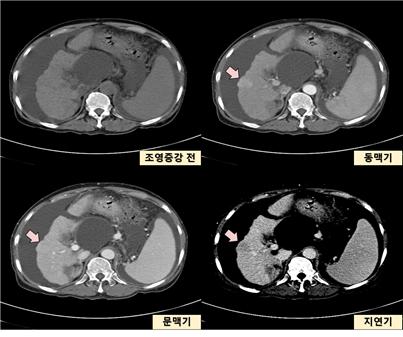 간세포암종 환자의 역동조영증강 CT. 출처 대한간학회