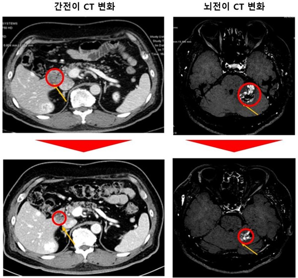  간과 뇌에 암이 전이된 환자의 간과 뇌종양 크기가 각각 감소한 모습, 암 병변은 87% 정도 감소했고 18개월 이상 반응을 유지 중이다. 출처 연세암병원