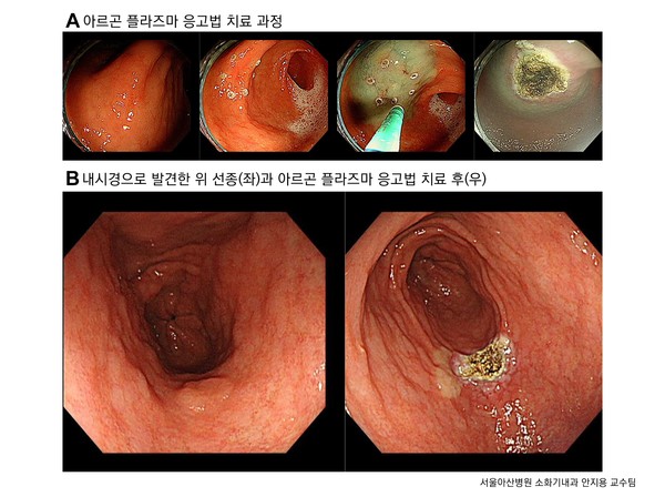 아르곤 플라즈마 응고법으로 위 선종을 치료하는 과정. 출처 서울아산병원