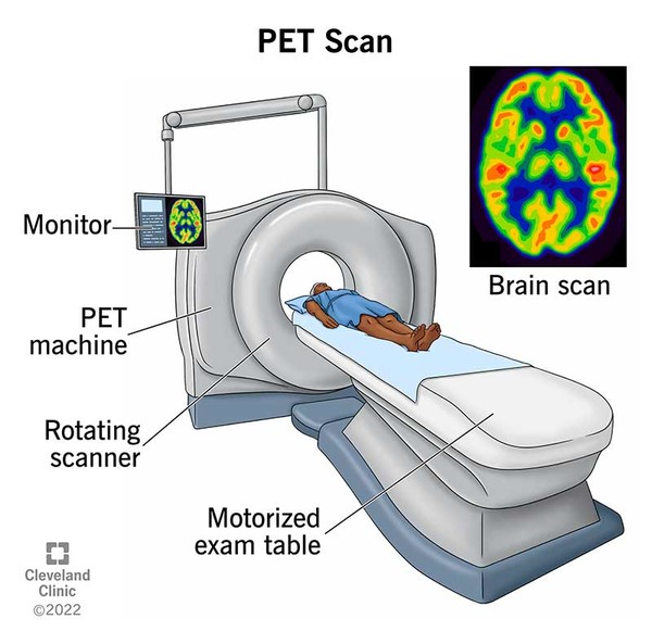 PET 스캔의 SUV 수치는 무엇을 의미할까 © Cleveland Clinic